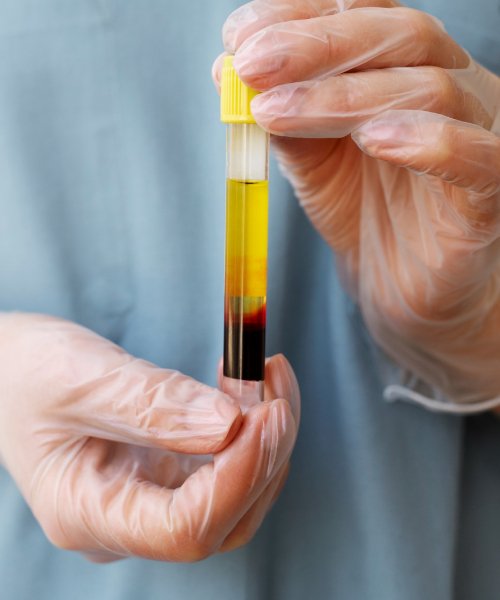 Rhumatologie de Pointe & Traitement par PRP à Marrakech